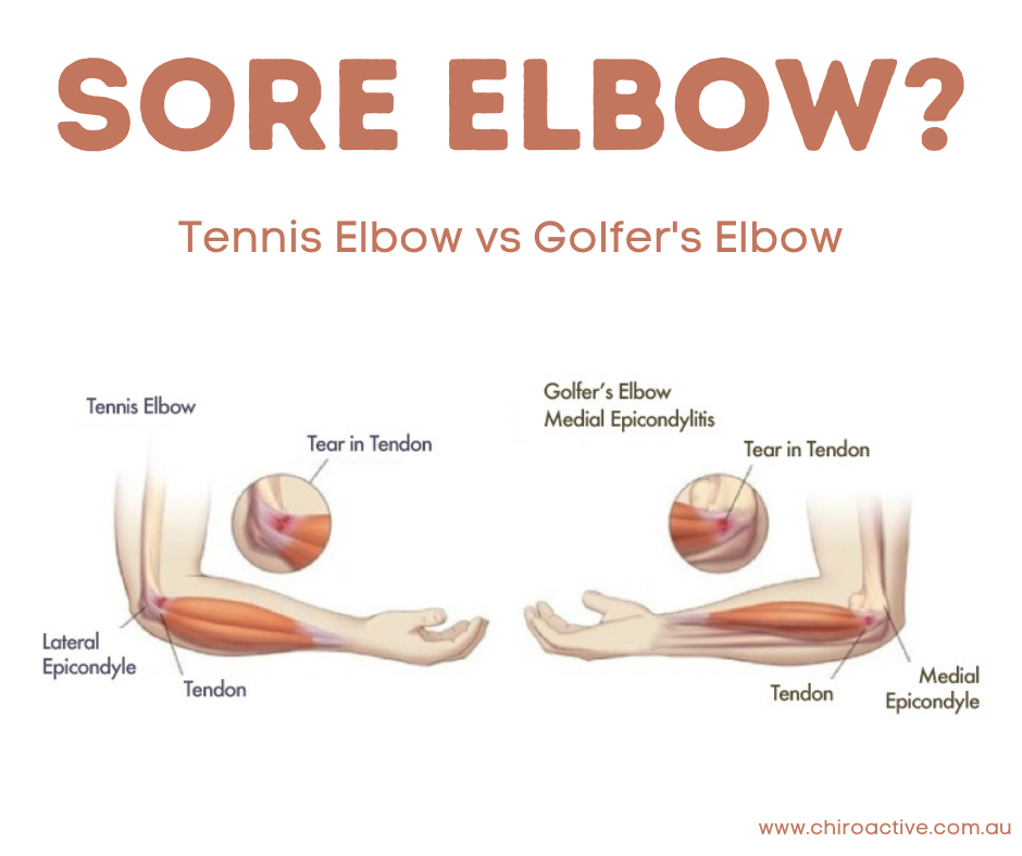Tennis Elbow and Golfer's Elbow